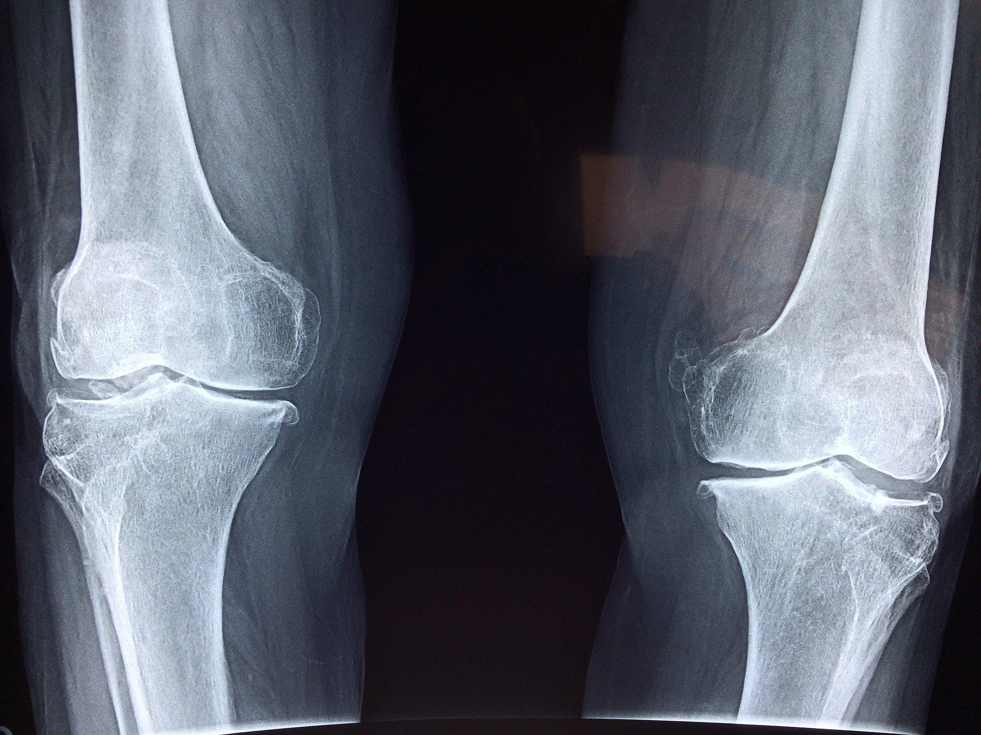 knee-2253047_1920 knee-2253047_1920