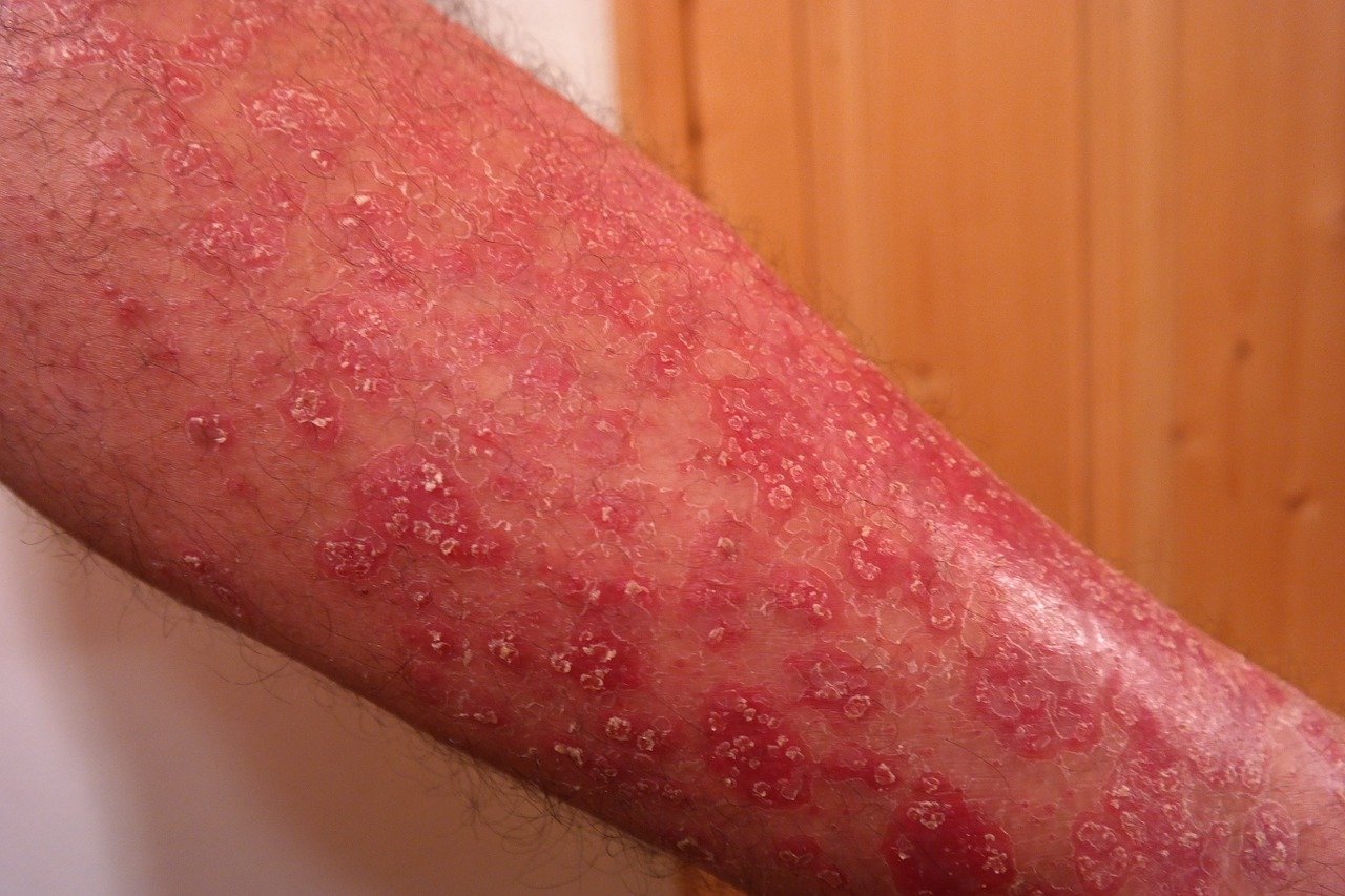psoriasis-356429_1280Imagen de Hans Braxmeier en Pixabay psoriasis-356429_1280Imagen de Hans Braxmeier en Pixabay